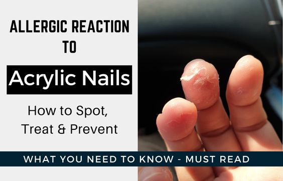 Allergic Reaction to Acrylic Nails- How to Spot & Treat